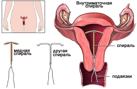 http://www.aborti.ru/sites/default/files/Image/kontra/spiral.jpg