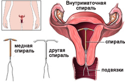 Внутриматочная спираль, ВМС