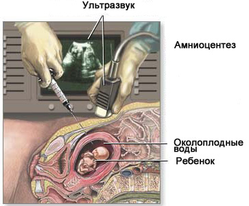 Амниоцентез. Амнио.